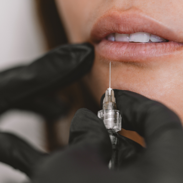 Lip Fillers