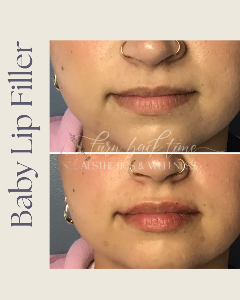 Baby Lip Filler